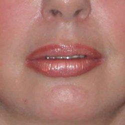 Lip Filler after at Plastic Surgeon Cleveland: Dr. Paul Vanek in Concord, OH