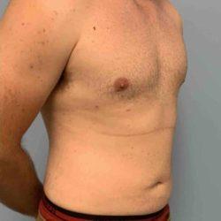 Gynecomastia Surgery after at Plastic Surgeon Cleveland: Dr. Paul Vanek in Concord, OH