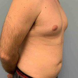 Gynecomastia Surgery before at Plastic Surgeon Cleveland: Dr. Paul Vanek in Concord, OH