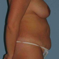 Mommy Makeover before at Plastic Surgeon Cleveland: Dr. Paul Vanek in Concord, OH