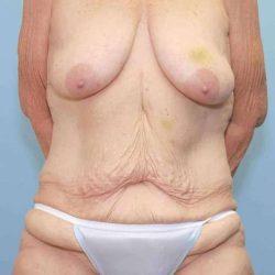 Mommy Makeover before at Plastic Surgeon Cleveland: Dr. Paul Vanek in Concord, OH