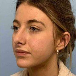 Rhinoplasty after at Plastic Surgeon Cleveland: Dr. Paul Vanek in Concord, OH