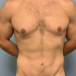 Gynecomastia Surgery after at Plastic Surgeon Cleveland: Dr. Paul Vanek in Concord, OH