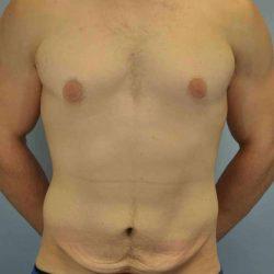 Gynecomastia Surgery before at Plastic Surgeon Cleveland: Dr. Paul Vanek in Concord, OH