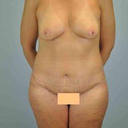 Mini Tummy Tuck after at Plastic Surgeon Cleveland: Dr. Paul Vanek in Concord, OH