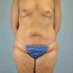 Mini Tummy Tuck before at Plastic Surgeon Cleveland: Dr. Paul Vanek in Concord, OH