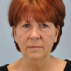 Facelift before at Plastic Surgeon Cleveland: Dr. Paul Vanek in Concord, OH
