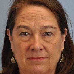 Blepharoplasty before at Plastic Surgeon Cleveland: Dr. Paul Vanek in Concord, OH