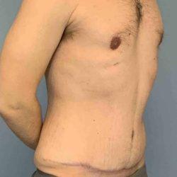 Tummy Tuck after at Plastic Surgeon Cleveland: Dr. Paul Vanek in Concord, OH