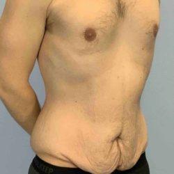 Tummy Tuck before at Plastic Surgeon Cleveland: Dr. Paul Vanek in Concord, OH