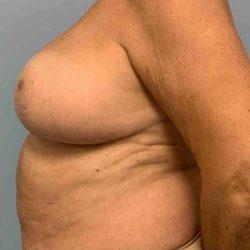 Breast Reduction after at Plastic Surgeon Cleveland: Dr. Paul Vanek in Concord, OH