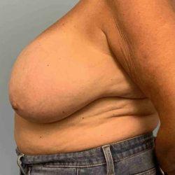 Breast Reduction before at Plastic Surgeon Cleveland: Dr. Paul Vanek in Concord, OH