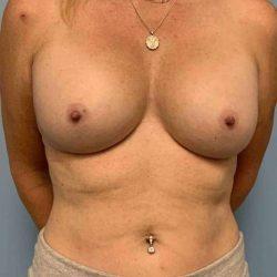 Breast Augmentation after at Plastic Surgeon Cleveland: Dr. Paul Vanek in Concord, OH