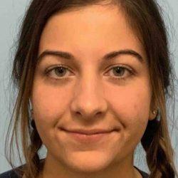 Functional Rhinoplasty after at Plastic Surgeon Cleveland: Dr. Paul Vanek in Concord, OH