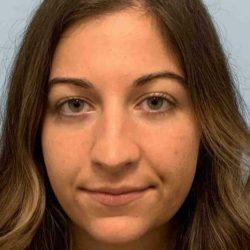 Functional Rhinoplasty before at Plastic Surgeon Cleveland: Dr. Paul Vanek in Concord, OH