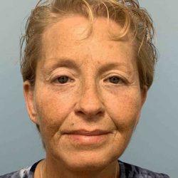 Plastic Surgeon Cleveland: Dr. Paul Vanek laser treatment after — Concord, OH