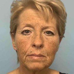 Laser Skin Resurfacing before at Plastic Surgeon Cleveland: Dr. Paul Vanek in Concord, OH