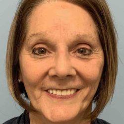 Plastic Surgeon Cleveland: Dr. Paul Vanek facelift after — Concord, OH