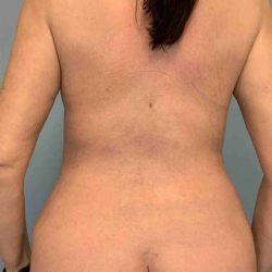 Liposuction after at Plastic Surgeon Cleveland: Dr. Paul Vanek in Concord, OH