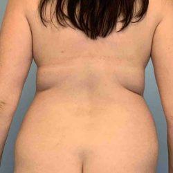Liposuction before at Plastic Surgeon Cleveland: Dr. Paul Vanek in Concord, OH