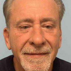 Blepharoplasty before at Plastic Surgeon Cleveland: Dr. Paul Vanek in Concord, OH