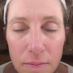 Plastic Surgeon Cleveland: Dr. Paul Vanek after — Concord, OH