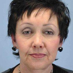 Plastic Surgeon Cleveland: Dr. Paul Vanek facelift after — Concord, OH