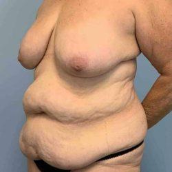 Mommy Makeover before at Plastic Surgeon Cleveland: Dr. Paul Vanek in Concord, OH