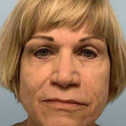 Blepharoplasty after at Plastic Surgeon Cleveland: Dr. Paul Vanek in Concord, OH