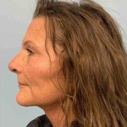 Facelift after at Plastic Surgeon Cleveland: Dr. Paul Vanek in Concord, OH