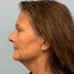 Facelift before at Plastic Surgeon Cleveland: Dr. Paul Vanek in Concord, OH