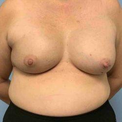 Breast Lift after at Plastic Surgeon Cleveland: Dr. Paul Vanek in Concord, OH