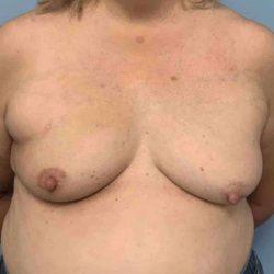 Breast Lift before at Plastic Surgeon Cleveland: Dr. Paul Vanek in Concord, OH
