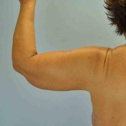 CoolSculpting after at Plastic Surgeon Cleveland: Dr. Paul Vanek in Concord, OH