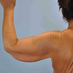 CoolSculpting before at Plastic Surgeon Cleveland: Dr. Paul Vanek in Concord, OH