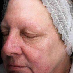 Laser Skin Resurfacing after at Plastic Surgeon Cleveland: Dr. Paul Vanek in Concord, OH