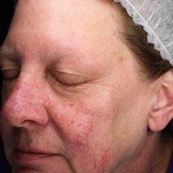 Laser Skin Resurfacing before at Plastic Surgeon Cleveland: Dr. Paul Vanek in Concord, OH