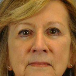 Blepharoplasty after at Plastic Surgeon Cleveland: Dr. Paul Vanek in Concord, OH