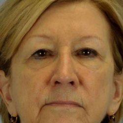 Blepharoplasty before at Plastic Surgeon Cleveland: Dr. Paul Vanek in Concord, OH