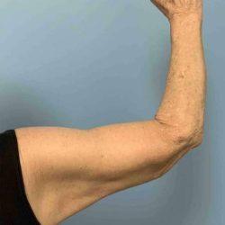 Arm Lift after at Plastic Surgeon Cleveland: Dr. Paul Vanek in Concord, OH