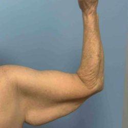 Arm Lift before at Plastic Surgeon Cleveland: Dr. Paul Vanek in Concord, OH