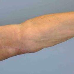 Arm Lift after at Plastic Surgeon Cleveland: Dr. Paul Vanek in Concord, OH