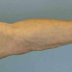 Arm Lift before at Plastic Surgeon Cleveland: Dr. Paul Vanek in Concord, OH