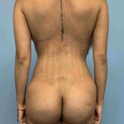 Brazilian Butt Lift after at Plastic Surgeon Cleveland: Dr. Paul Vanek in Concord, OH