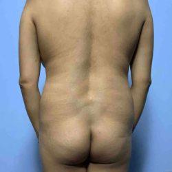 Brazilian Butt Lift before at Plastic Surgeon Cleveland: Dr. Paul Vanek in Concord, OH