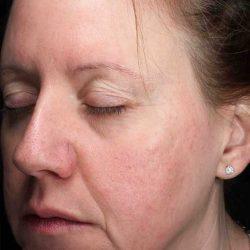 Plastic Surgeon Cleveland: Dr. Paul Vanek laser treatment after — Concord, OH