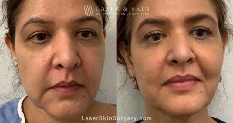 Dr. Lloyd Hoffman laser treatment result — New York, NY