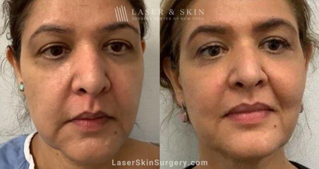 Laser Skin Resurfacing result at Dr. Lloyd Hoffman in New York, NY