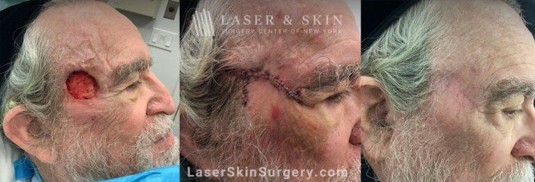 Dr. Lloyd Hoffman laser treatment result — New York, NY