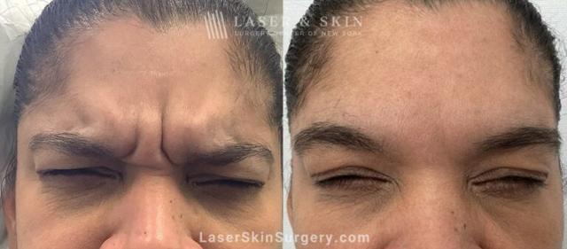 Laser Skin Resurfacing result at Dr. Lloyd Hoffman in New York, NY